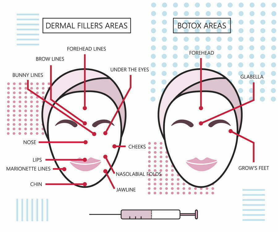 Infograthic Poster About Dermal Fillers Granite Bay Cosmetic Surgery