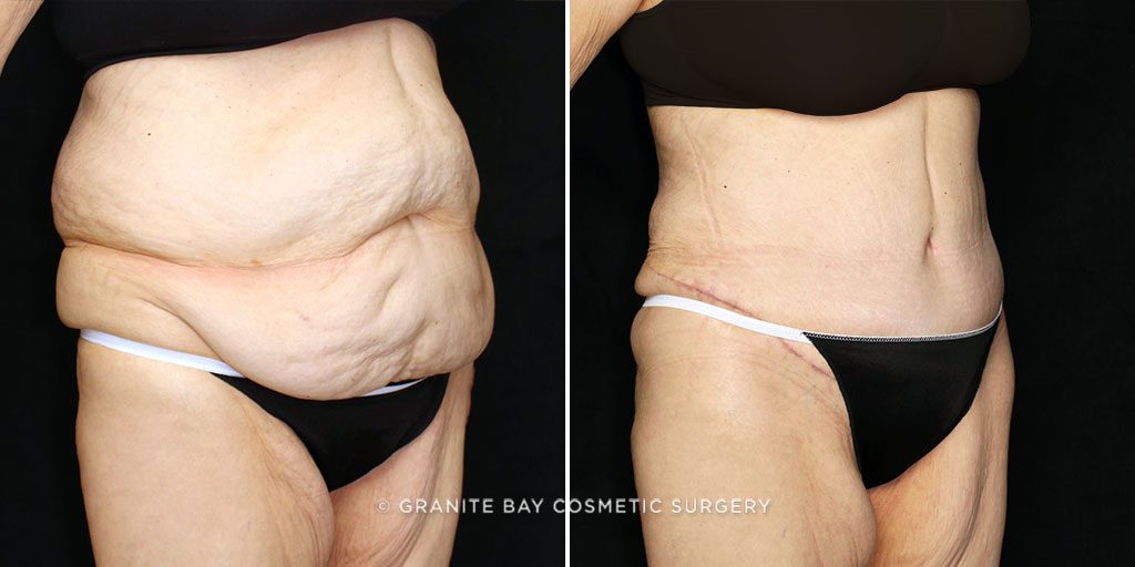 Liposuction - Abdominal Etching & Sculpting Before and After Pictures Case  974, Los Angeles, CA