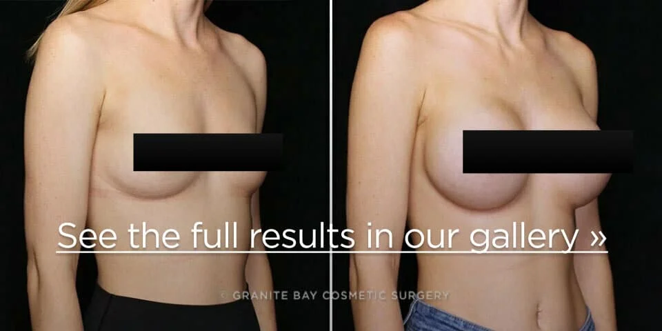 What do breast augmentation scars look like? - Granite Bay Cosmetic Surgery