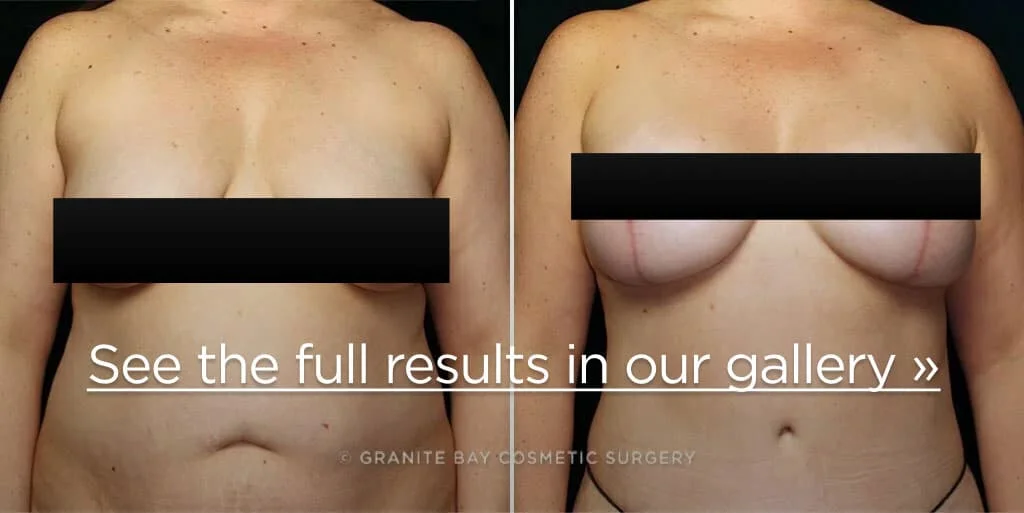 What Real Breast Lift Scars Look Like on 8 Patients